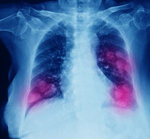 Non-small cell lung cancer