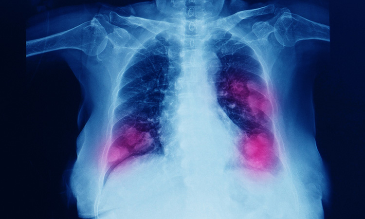 Non-small cell lung cancer