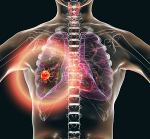 3D illustration of a red tumour in anatomically accurate human torso with lungs - idea of lung cancer