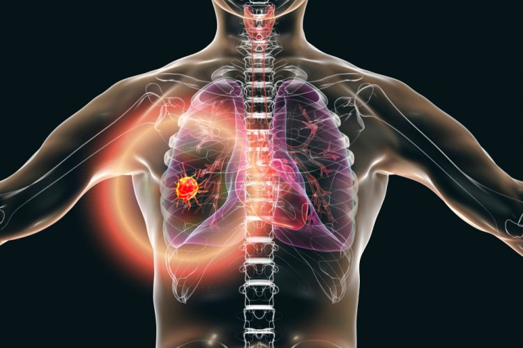 3D illustration of a red tumour in anatomically accurate human torso with lungs - idea of lung cancer