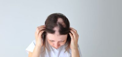 MHRA authorises Lufico alopecia treatment for those 12+