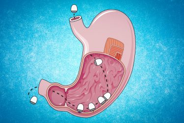 MIT researchers have designed an ingestible capsule that, after being swallowed, can attach itself to the lining of the stomach and inject RNA [Credit: MIT researchers, edited by MIT News].