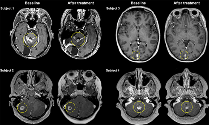 MR images showing reduction in size of metastatic tumors after focused-ultrasound delivery of antibody therapy through blood-brain barrier [Credit: Sunnybrook Health Sciences Centre].
