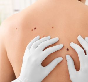 Oncologist’s gloved hands examining a mole/potential melanoma on someone’s back.
