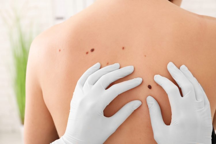 Oncologist’s gloved hands examining a mole/potential melanoma on someone’s back.