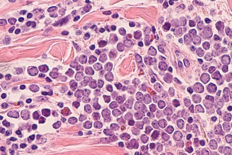 photomicrograph of a Merkel cell carcinoma, a highly aggressive type of skin cancer, derived from neuroendocrine cells, typically of the face, head or neck.