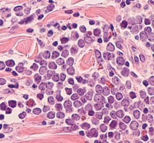 photomicrograph of a Merkel cell carcinoma, a highly aggressive type of skin cancer, derived from neuroendocrine cells, typically of the face, head or neck.