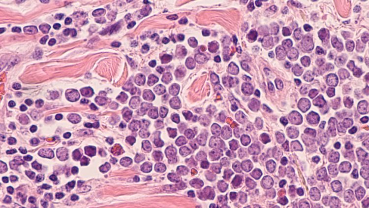 photomicrograph of a Merkel cell carcinoma, a highly aggressive type of skin cancer, derived from neuroendocrine cells, typically of the face, head or neck.