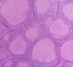 Microscopic image of follicular lymphoma, a type of non-Hodgkin lymphoma