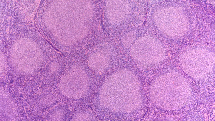 Microscopic image of follicular lymphoma, a type of non-Hodgkin lymphoma