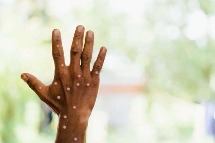 Black person's hand affected by monkeypox - lumpy white rash