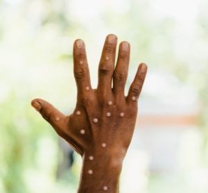 Black person's hand affected by monkeypox - lumpy white rash