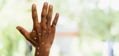 Black person's hand affected by monkeypox - lumpy white rash