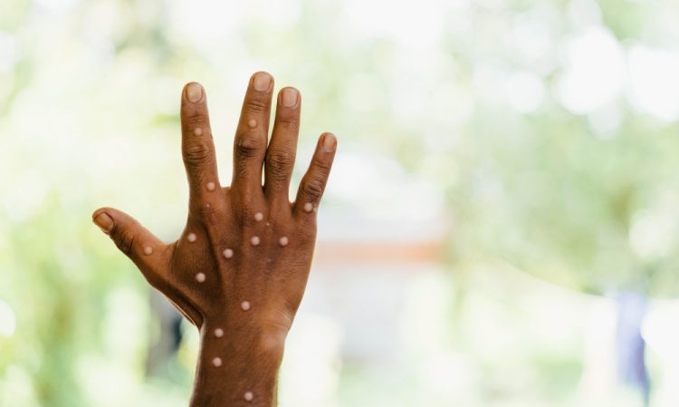 Black person's hand affected by monkeypox - lumpy white rash