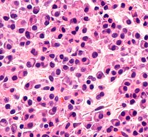 Pathology microscopic of bone biopsy of multiple myeloma