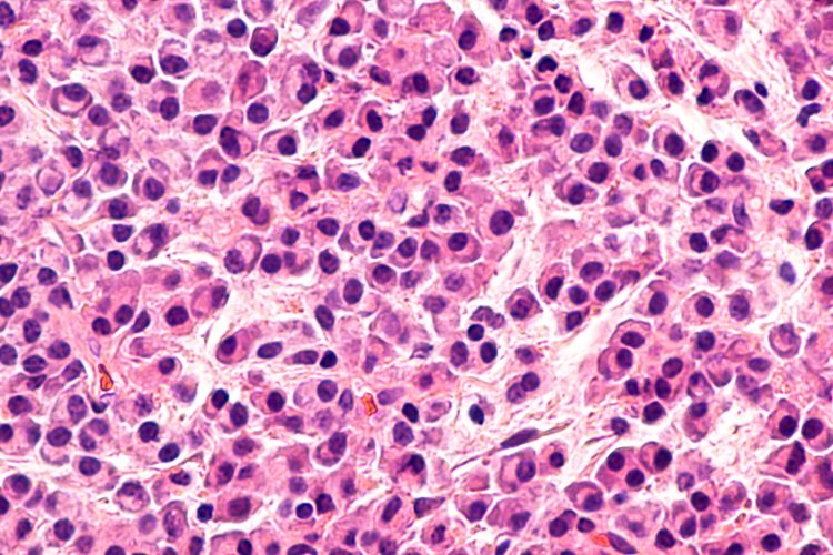 Pathology microscopic of bone biopsy of multiple myeloma