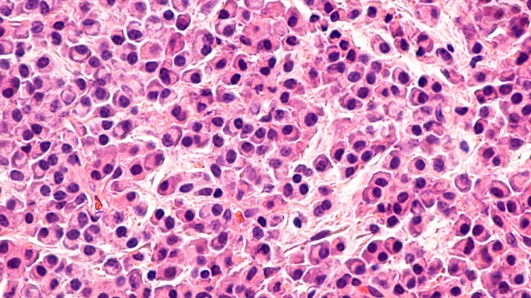 Pathology microscopic of bone biopsy of multiple myeloma