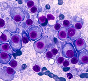 Bone marrow aspirate cytology of multiple myeloma, a type of bone marrow cancer of malignant plasma cells, associated with bone pain, bone fractures and anemia.