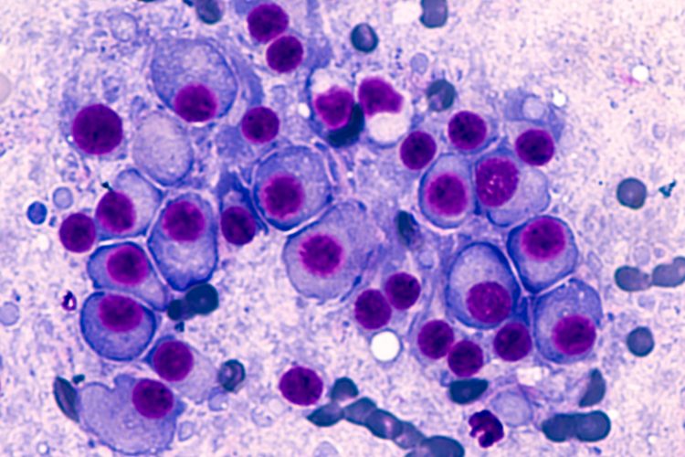Bone marrow aspirate cytology of multiple myeloma, a type of bone marrow cancer of malignant plasma cells, associated with bone pain, bone fractures and anemia.