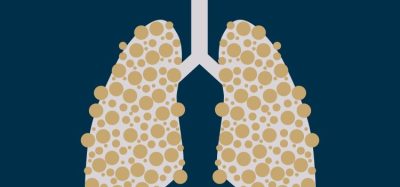 Chemo-free regimen demonstrates efficacy in NSCLC - Rybrevant and lazertinib