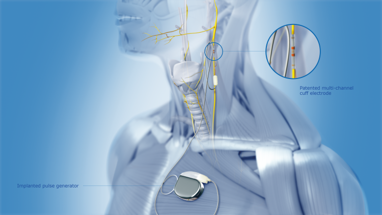 Neuroloops neurostimulation system consists of a unique, patented and very thin multi-channel cuff electrode that is wrapped around the vagus nerve. The electrode is connected to an implanted pulse generator in the chest area, which is wirelessly charged and programmed. The platform allows for selective stimulation of the vagus nerve and sets new standards for treating chronic diseases associated with autonomous vital functions [Credit: neuroloop GmbH].