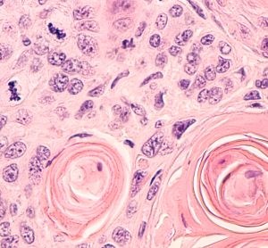 Lung cancer photomicrograph