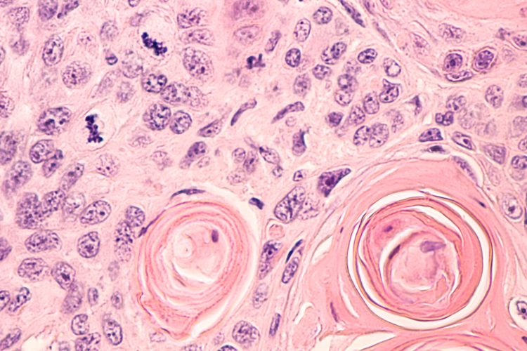 Lung cancer photomicrograph