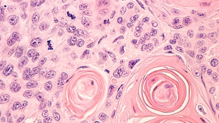 Lung cancer photomicrograph