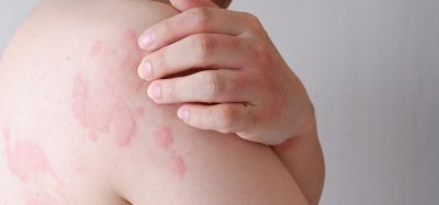 Will Novartis deliver remibrutinib as new oral option for chronic hives?
