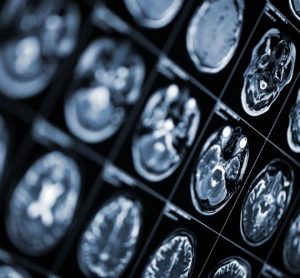 Roche multiple sclerosis subcutaneous injection: late-breaking data