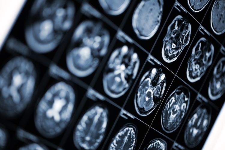 Roche multiple sclerosis subcutaneous injection: late-breaking data