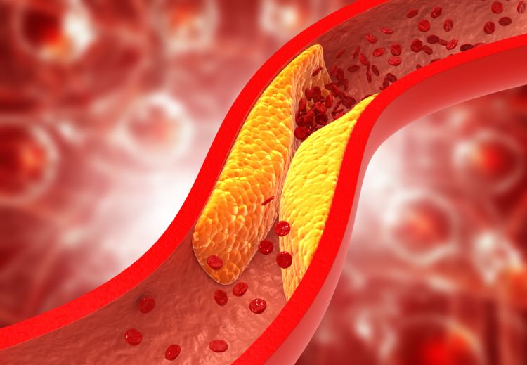 Oral PCSK9 inhibitor substantially reduces cholesterol, study finds