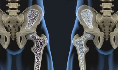 osteoporosis