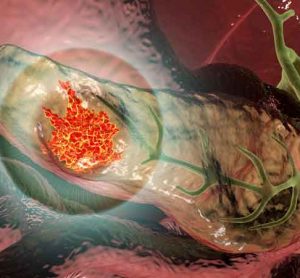 The study shows that the immune system can recognise neoantigens in pancreatic cancer, and that mRNA vaccines can be used to stimulate T cells to recognise neoantigens in pancreatic cancer patients.