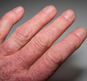 RINVOQ to treat psoriasis