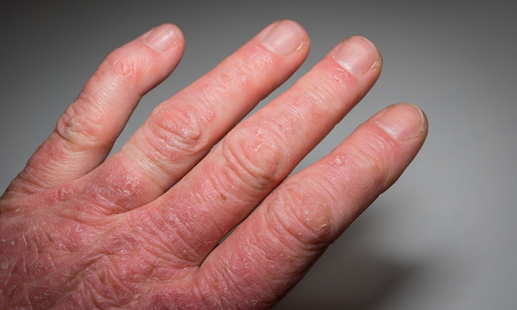 RINVOQ to treat psoriasis