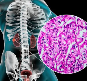 Anatomy of human torso with kidneys highlighted and a cut-away with a light microscope showing renal cell carcinoma cells