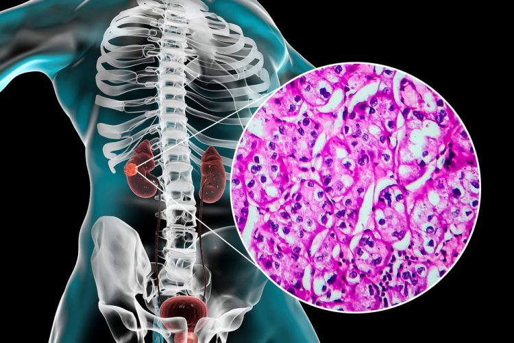 Anatomy of human torso with kidneys highlighted and a cut-away with a light microscope showing renal cell carcinoma cells