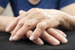 Rheumatoid Arthritis narrative