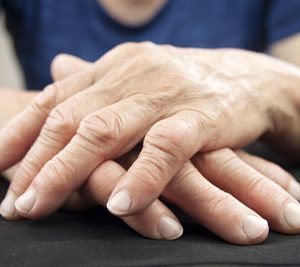 Rheumatoid Arthritis