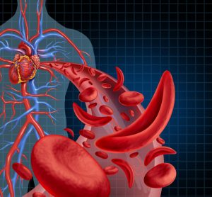 3D illustration of human anatomy with a cut away of normal and sickled red blood cells in an artery - idea of sickle cell disease