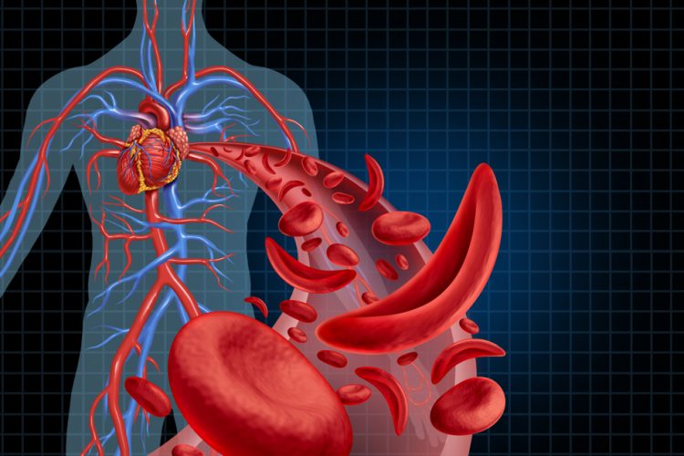 3D illustration of human anatomy with a cut away of normal and sickled red blood cells in an artery - idea of sickle cell disease