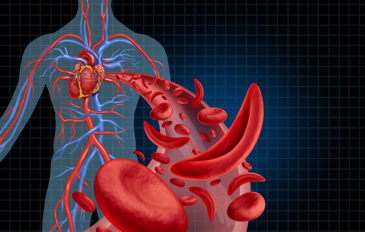 3D illustration of human anatomy with a cut away of normal and sickled red blood cells in an artery - idea of sickle cell disease