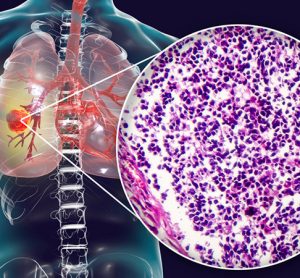 Small cell lung cancer - Imfinzi treatment