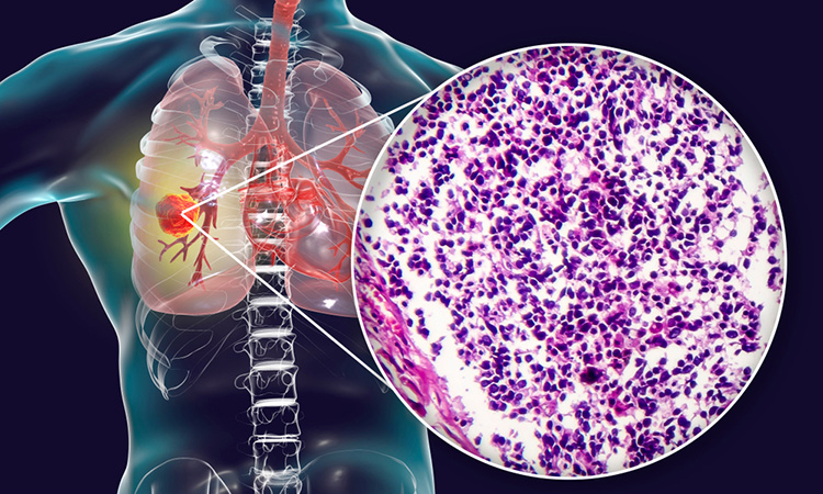 Small cell lung cancer - Imfinzi treatment