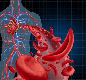 Sickle cell disease concept - blood vessel with some normal and some sickled blood cells with illustration of cardiovascular system behind