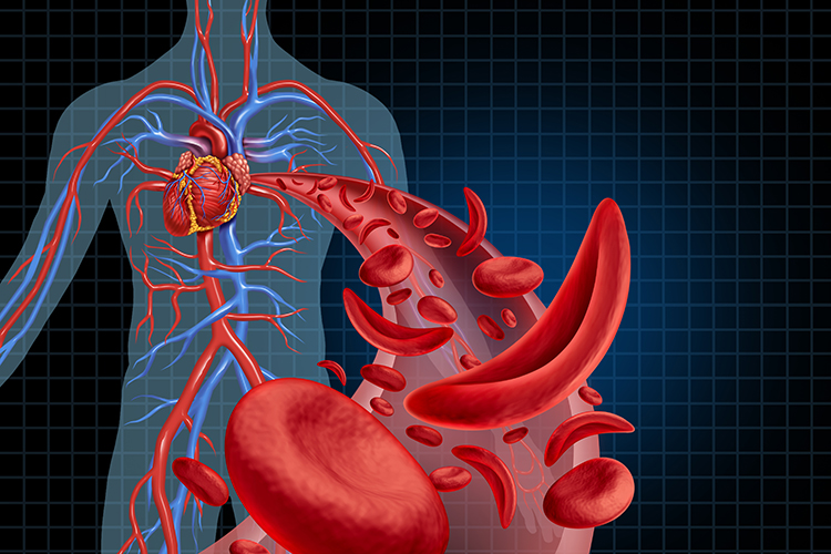 Sickle cell disease concept - blood vessel with some normal and some sickled blood cells with illustration of cardiovascular system behind