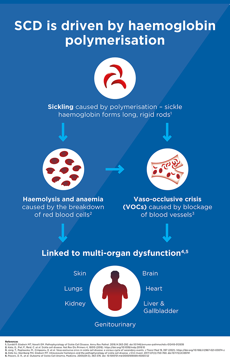 Diagram of how sickle cell disease occurs, driven by haemoglobin polymerisation