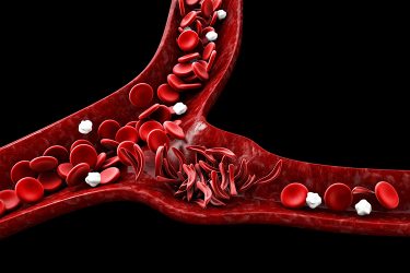 sickle cell disease 3D illustration showing blood vessel with normal and deformed crescent or sickled red blood cells