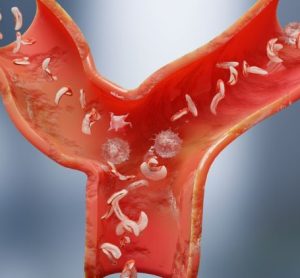 Stem cell therapy delivers potential for sickle cell disease